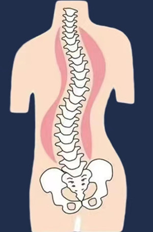 如何有效改善脊柱側(cè)彎