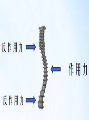 什么是脊柱側(cè)彎矯形器？